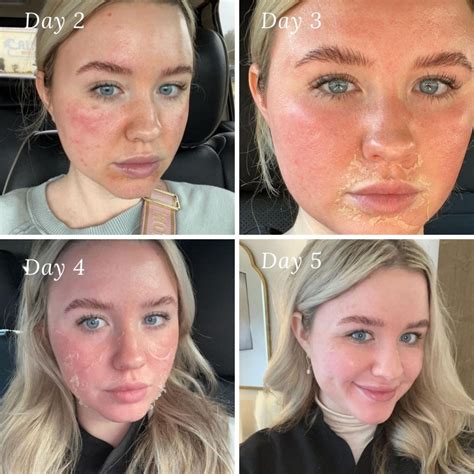 how many glycolic peels to see results|Everything You Need to Know About Glycolic Acid .